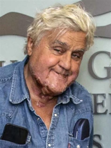 Jay leno burns - Jay Leno sat down with Hoda Kotb on the ‘Today’ show on Wednesday and opened up about the garage accident that left him with third degree burns on his face l...